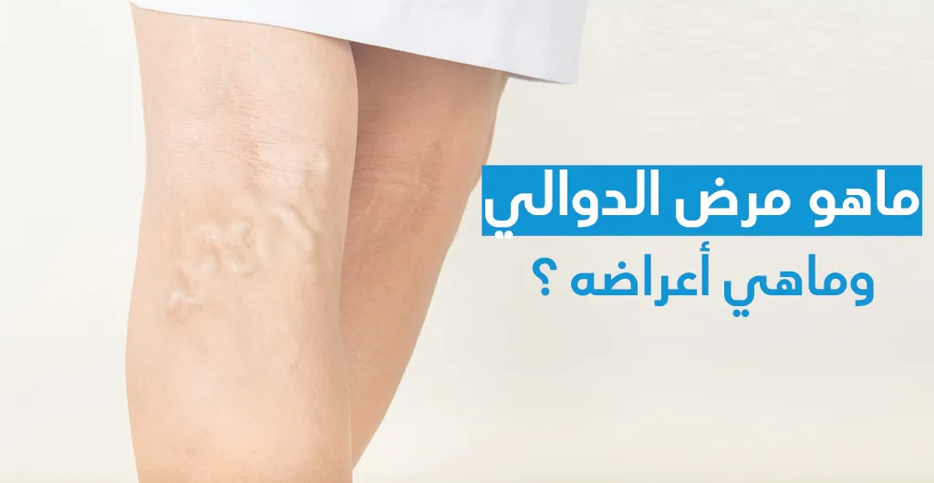 ماهو مرض الدّوالي وماهي أعراضه ؟